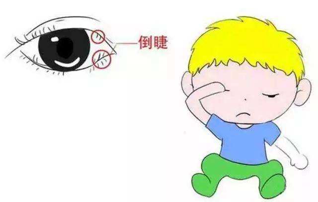 眼睛總有刺痛感？可能是倒睫惹的禍