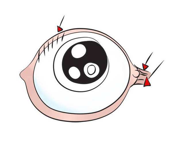 倒睫是什么？有哪些癥狀和危害？