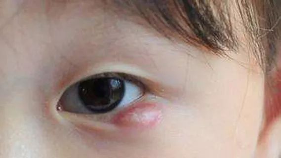 小孩子得了霰粒腫要怎么辦？按摩？熱敷？手術？...